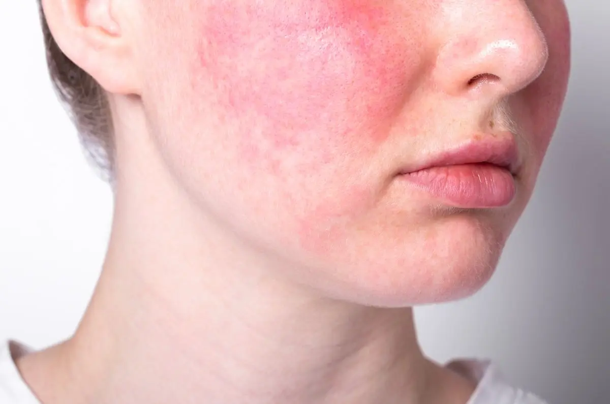 Czy moja twarz jest czerwona po HydraFacial?
