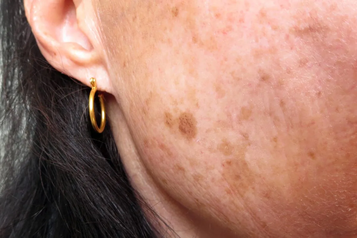 Kolagen a redukcja przebarwień. Co trzeba wiedzieć?